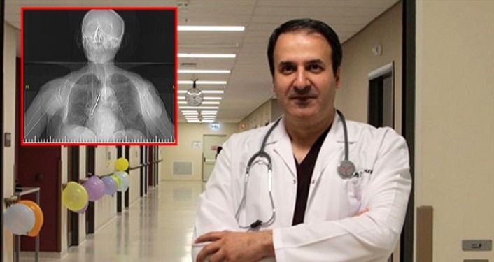 Турецкие врачи вынули из легкого пациента 10-сантиметровый гвоздь