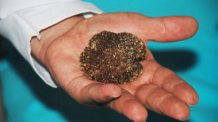В Турции из мочевого пузыря пациента извлекли камень весом 220 грамм
