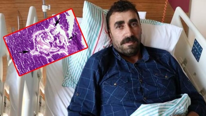 Турецкие онкологи удалили из легкого пациента большое насекомое