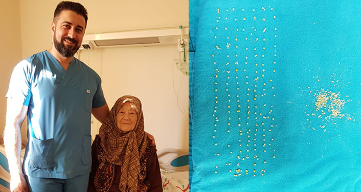 В Турции 94-летней пациентке удалили 200 камней из желчного пузыря