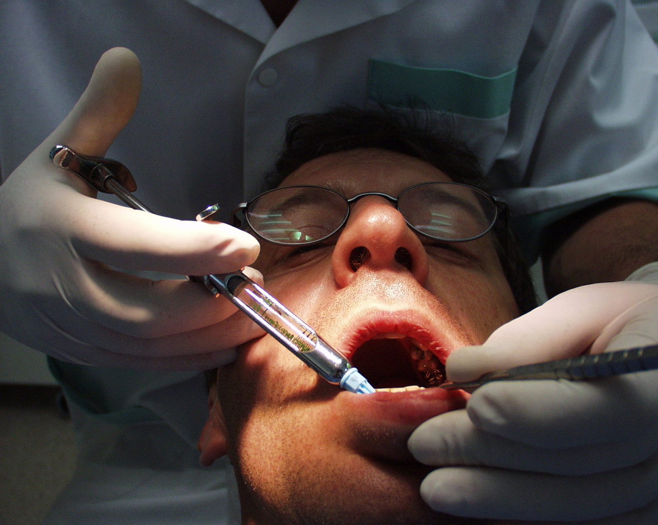 Поиск стоматолога-терапевта в Анталии для лечения кисты на здоровом зубе