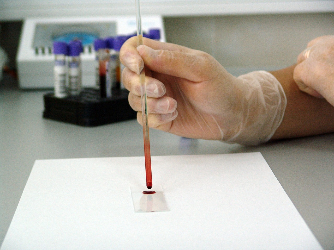 В каких единицах измеряется гемоглобин при анализах в турецкой медицине?  