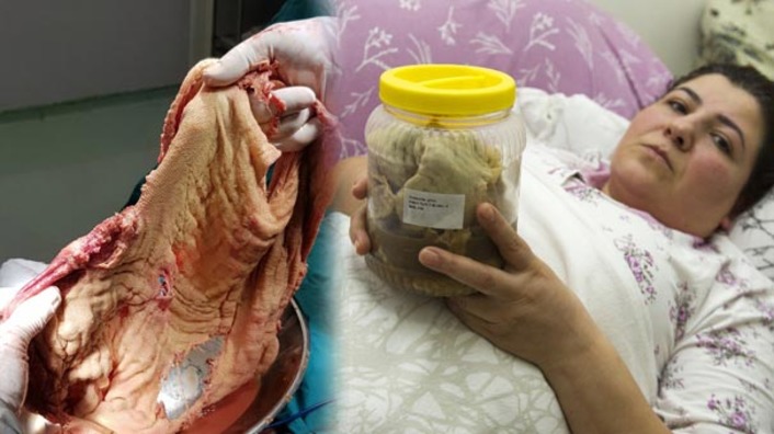 В Анкаре врачи после операции оставили в животе пациентки 2 кг марли