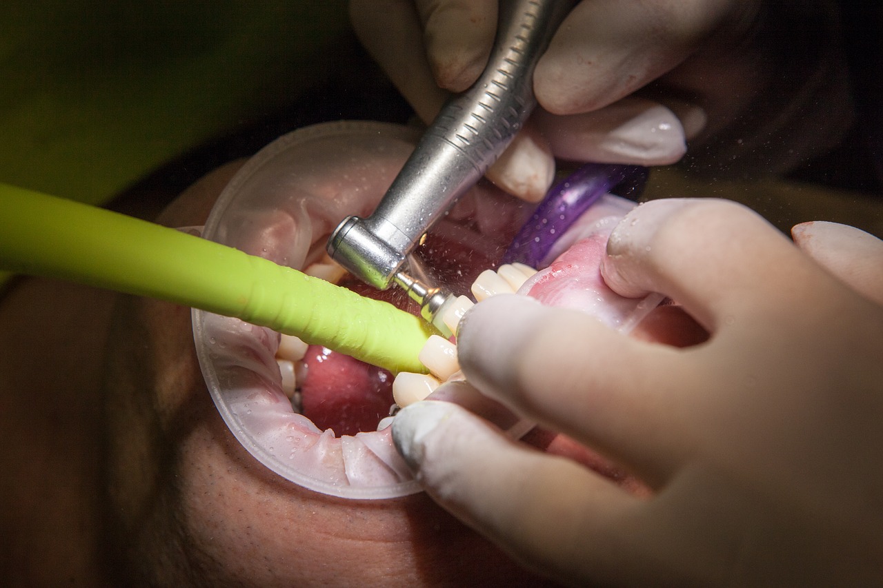  Гарантии при пломбировании зубов турецкими стоматологами 