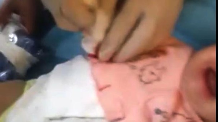 Медбрат в Шанлыурфе отрезал ребенку палец ножницами (фото)