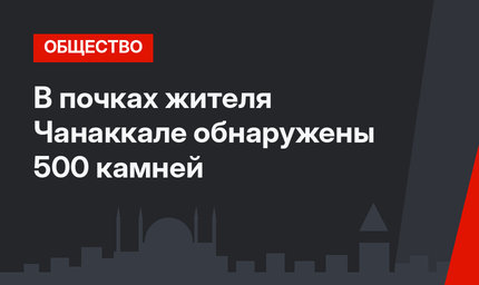 В почках жителя Чанаккале обнаружены 500 камней