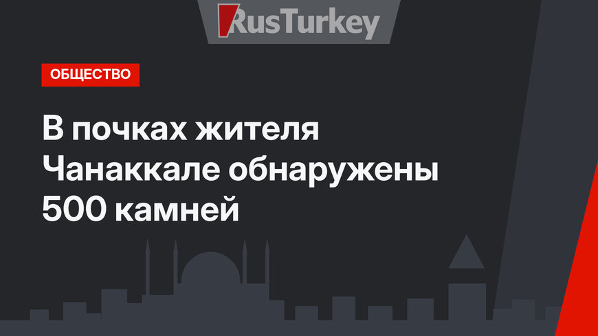 В почках жителя Чанаккале обнаружены 500 камней